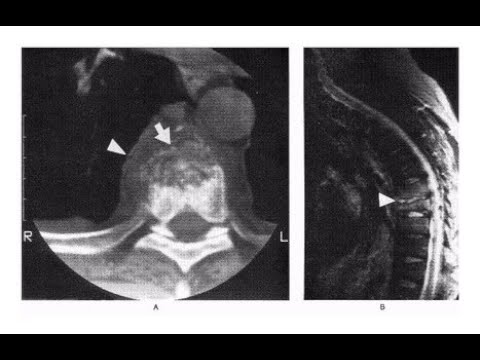 Video: Osteomyelitis Der Wirbelsäule