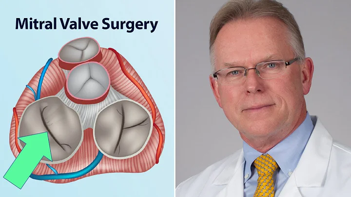 Mitral Valve Surgery: What Should Patients Know? (...