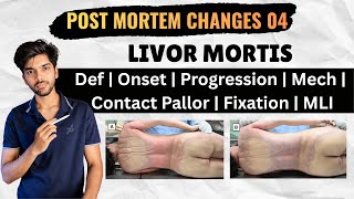 Information Post Mortem Changes 04 - Livor Mortis (Everything You Need To Know) Update