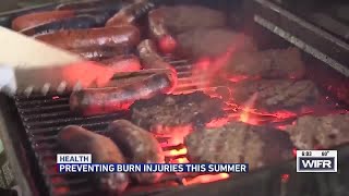 UW Health offers tips to prevent burn injuries as outdoor activities ramp up
