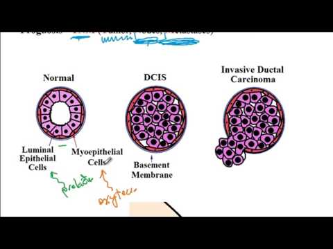 240 Breast disorders, fibrocystic disease, mammary duct ectasia, USMLE Step 1, USMLE ACE