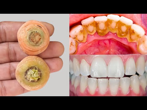 Teeth Whitening in Seconds Removes Yellowing and Drops Tartar | Teeth Whitening at Home