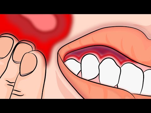 Come fermare il vostro mal di denti dolore immediatamente e naturalmente!