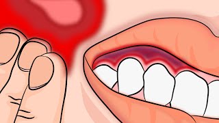 How to Stop your Toothache Pain INSTANTLY and Naturally!