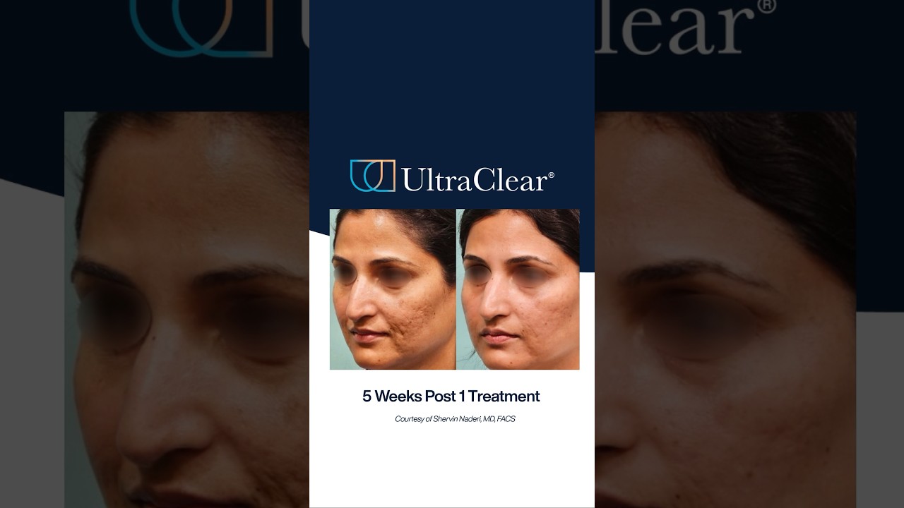 An UltraClear transformation in just 5 weeks! ✨#ultraclearlaser #beforeandafter