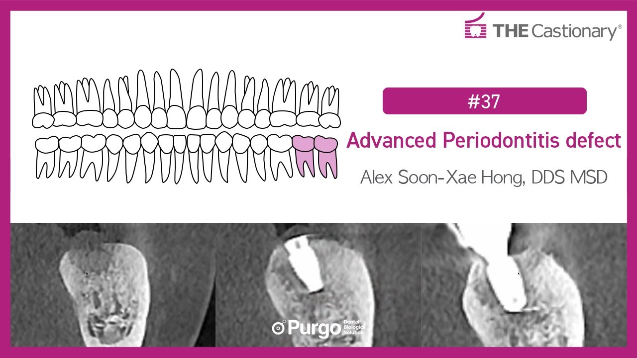 [#37] Advanced Periodontitis defect - YouTube