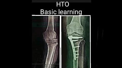 HTO for beginners Part 1||Basic HTO||Fujisawa poin...