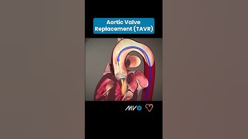 🫀Transcatheter Aortic Valve Replacement (TAVR) 🫀 #anatomy #doctor