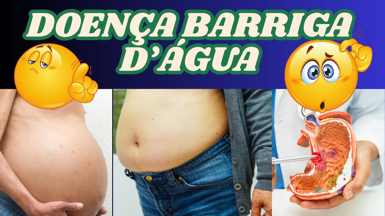 DICAS DE SAÚDE DR MARCELO SANDRIN: DOENÇA DA BARRIGA D'ÁGUA E SUAS ...