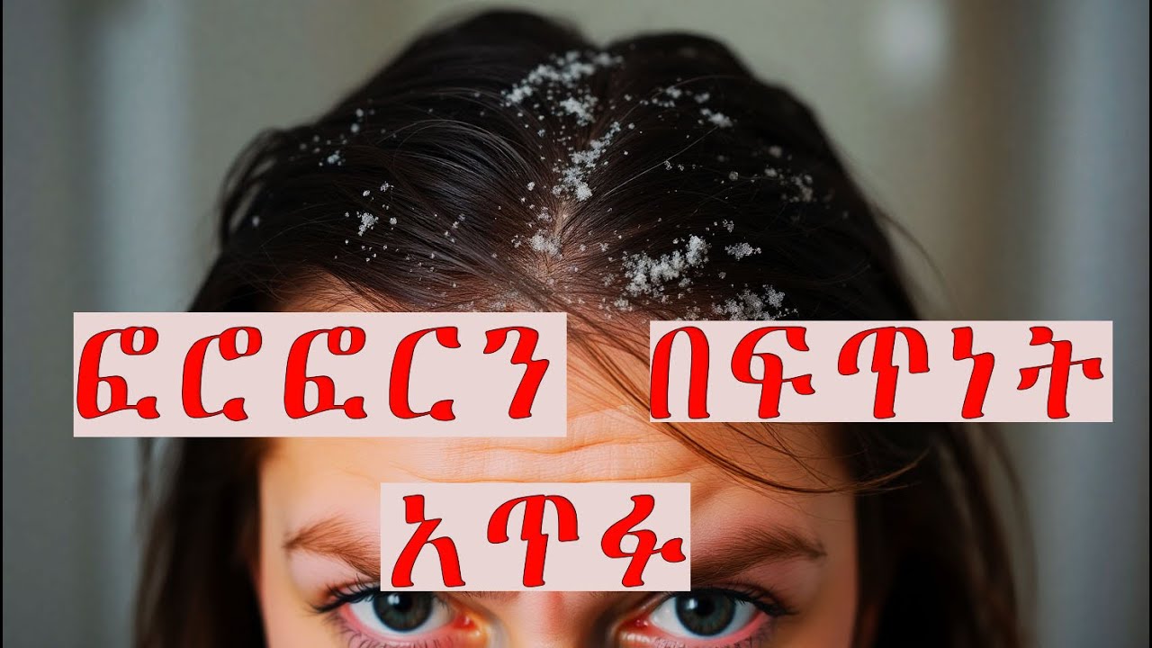 ፎሮፎርን በተፈጥሮአዊ መንገድ በፍጥነት ለማጥፋት(አስገራሚ ለውጥ - YouTube