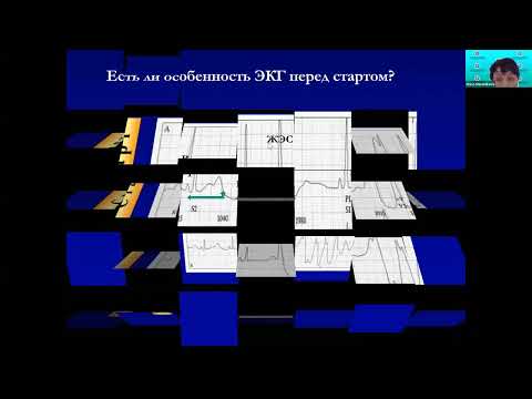 Жизнеугрожающие аритмии у