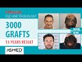 Manual FUE Hair Transplant Result 3000 Graft 13 Years #hairtransplant #saçekimi