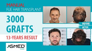 Manual FUE Hair Transplant Result 3000 Graft 13 Years #hairtransplant #saçekimi