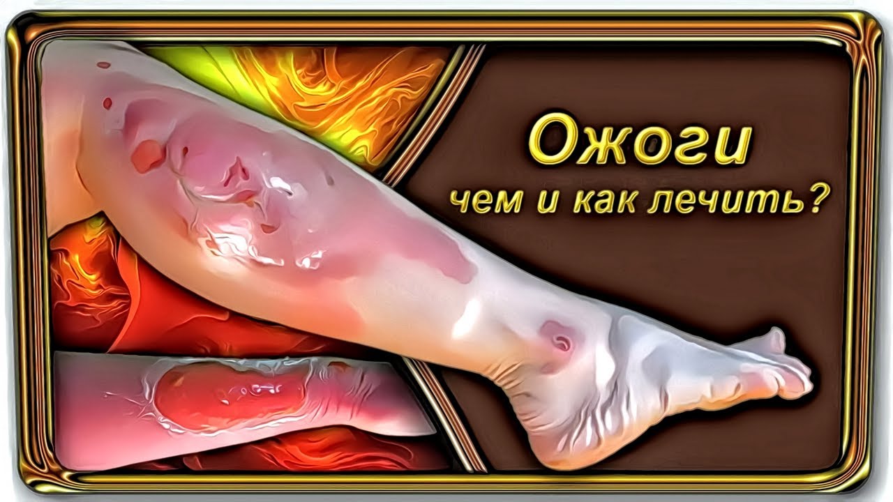 Ожог, чем и как лечить. Термические ожоги.