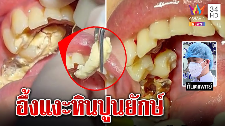 สยอง! หินปูนก้อนโตเกาะฟันนานนับปี หมอเหงื่อตกเคลียร์1ชั่วโมงเผยพบบ่อยในคนชายขอบ|ทุบโต๊ะข่าว|19/01/65