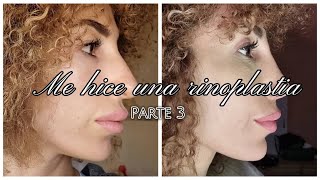 Mi Experiencia con la RINOPLASTIA👃🏼 | Proceso Part 3