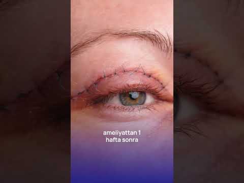 Göz Kapağı Düşüklüğünün Tedavisi Var Mıdır Gözsağlığı Gözkapağıestetiği Gözkapağıdüşüklüğü