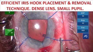 TBWTDCS #172: Dense Lens. Tiny Pupil. My Easy & Efficient 5 Iris Hook Placement & Removal Technique