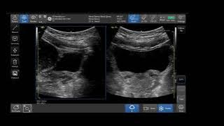 Venue Family | How to obtain a bladder volume