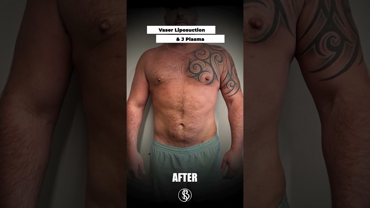 Vaser Liposuction & J Plasma! #shorts