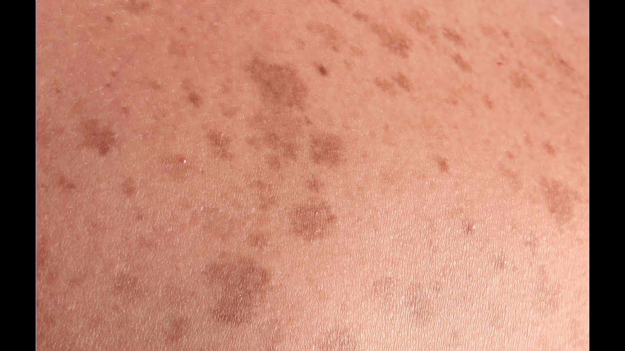 manchas oscuras en el tipo de diabetes corporal