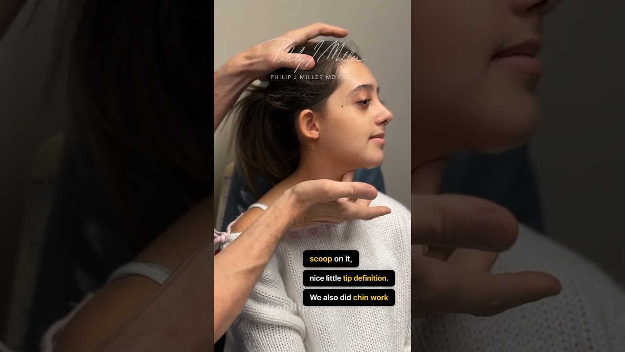 7 Days Post Op Rhinoplasty and Chin Implant! Facial Balancing & Fixing Deviated Septum