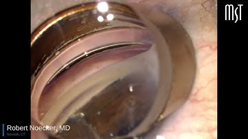 Dr. Robert Noecker TrabEx Pro Surgical Video