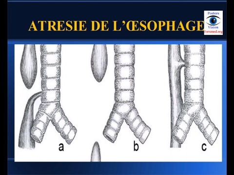 Vidéo: Atrésie De L'œsophage: Conséquences, Causes, Diagnostic, Traitement