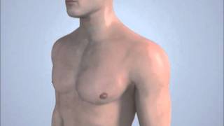 Herniation ( t8-t9 )