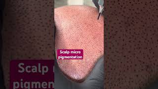 Scalp micropigmentation.Easy to understand #microblade #microblading#scalppigmentation #pigmentation