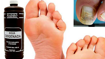 ¿Puedes remojar los pies en agua oxigenada?