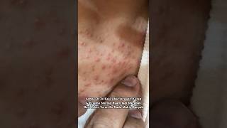 RUAM PSORIASIS MEREBAK MAKIN BANYAK SELEPAS SAPU CREAM STEROID ECZEMA - DrMan Ttdi Story