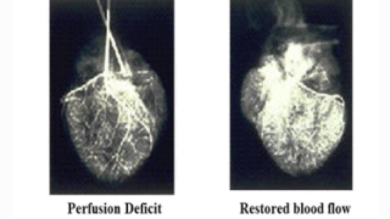 Coronary Collateral Angiogenesis
