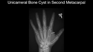 Unicameral Bone Cysts in Hands screenshot 5