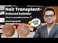 Hair Transplant–Induced Keloids: Causes, Treatment Options?  | Ask Me ft. Dr Jangid