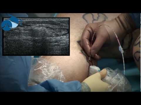 TRLOP closure of incompetent perforating vein (IPV)