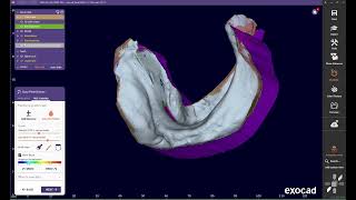 exocad BPS GOTHIC PLATE DESIGN