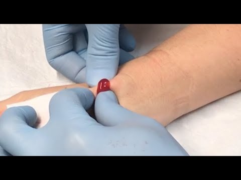 Video: Hygrom Des Handgelenks - Behandlung, Entfernung