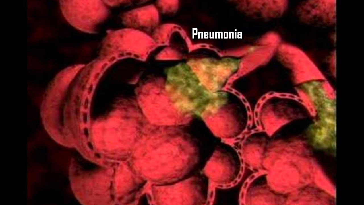 The Diseases of the Respiratory System - YouTube