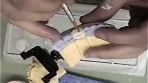 Dental Crown- 2 layer Porcelain Build-Up Complete PFM- ASMR