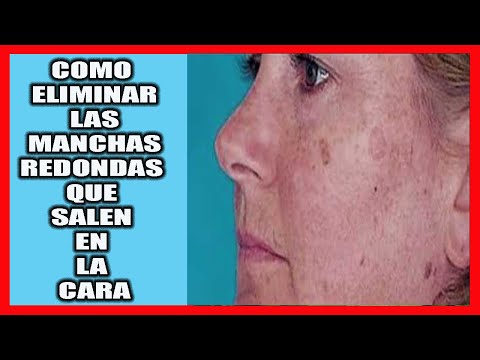 manchas redondas en la piel
