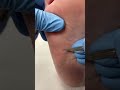 Step into comfort with this amazing midfoot corn removal! Watch as our expert podiatrist works