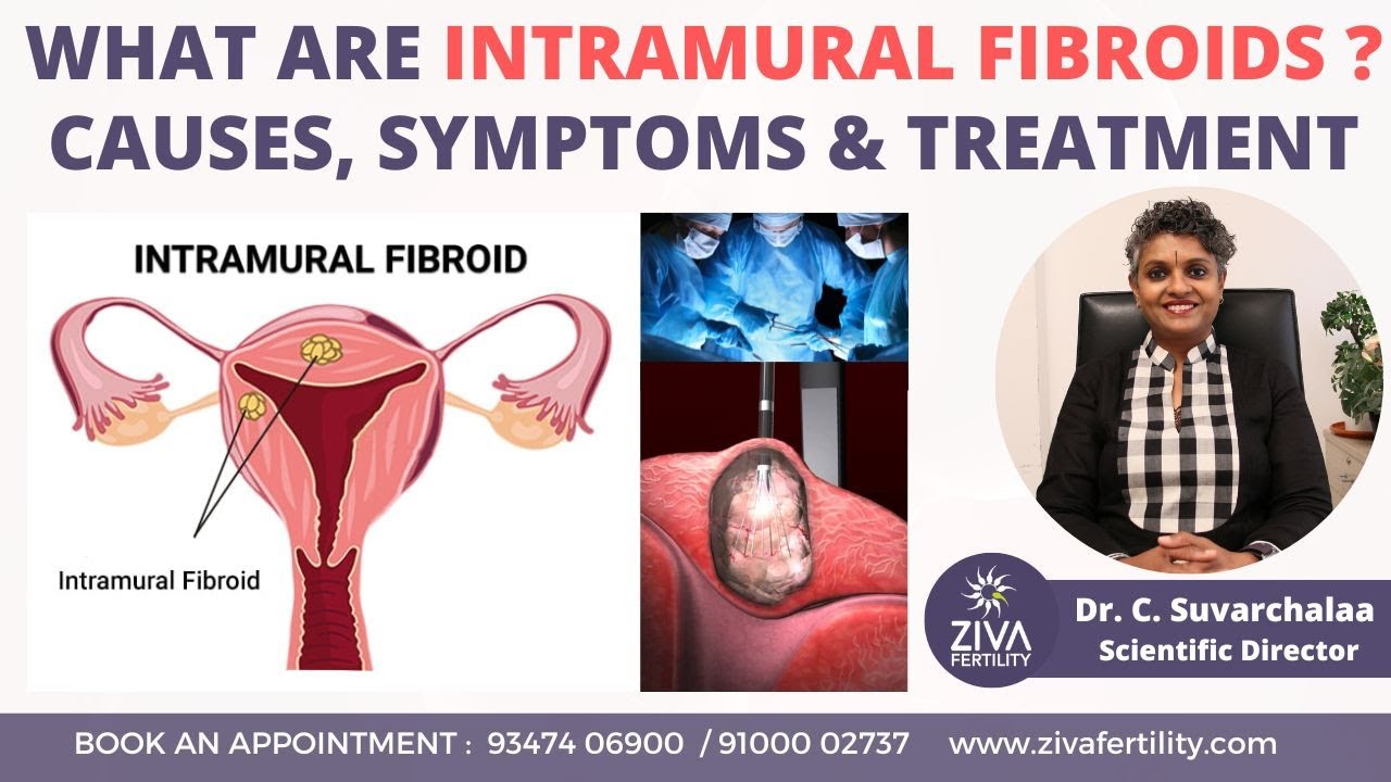 Intramural Fibroid : Causes, Symptoms and Treatment || Dr C Suvarchalaa ...