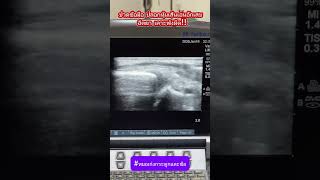 ปวดข้อมือ ปลอกหุ้มเส้นเอ็นอักเสบ ฉีดยา เลาะพังผืด!!