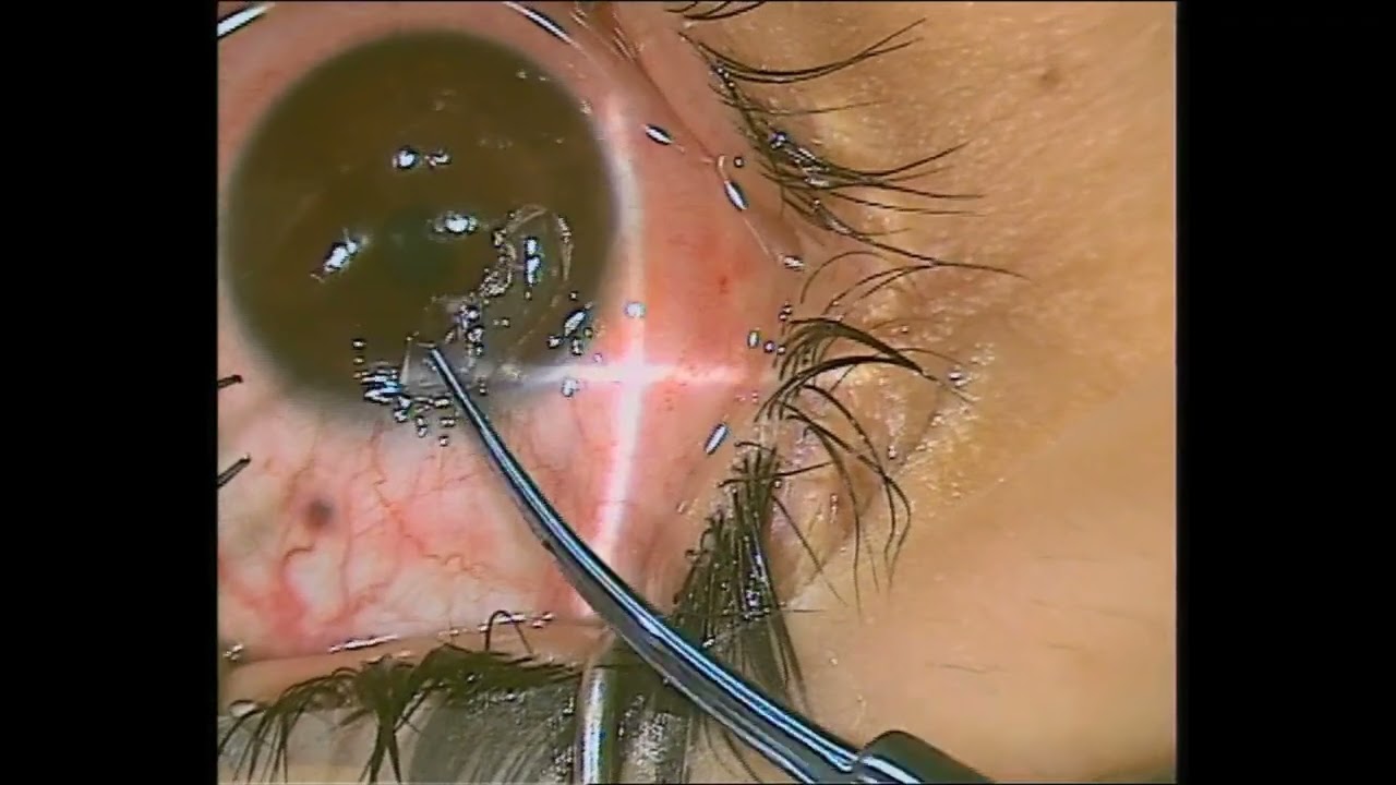 Dr. Adel Barbara performing CAIRS surgery for keratoconus