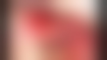 Simplified ridge and sinus augmentation using Sticky Porcine Bone Graft and SANTA