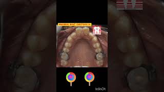 Braces treatment success story@Himanshu dant chikitshalya