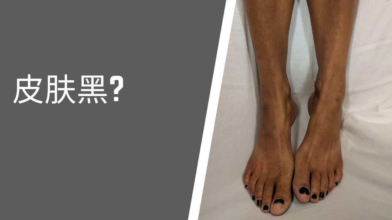 北美儿科/Addison's disease/爱迪生氏病/青铜色皮病 - YouTube