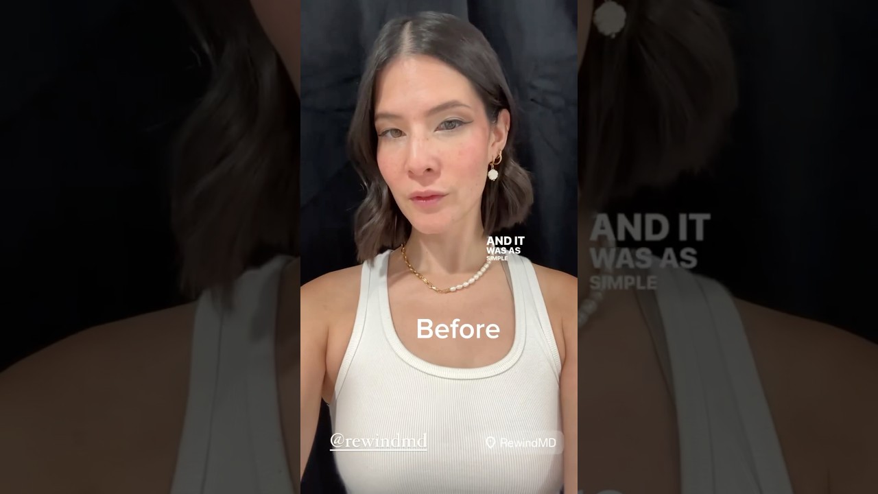 Lip Laser Treatment Before & After