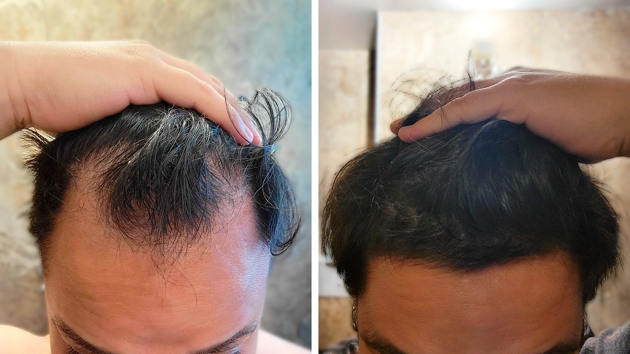 Su Pelo Vuelve De Entre Los Muertos En 100 Días